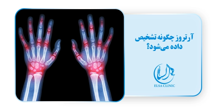 آرتروز چگونه تشخیص داده می‌شود؟