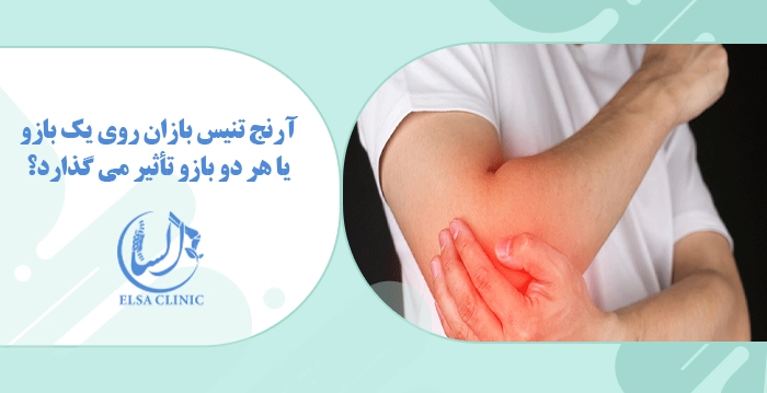 آرنج تنیس بازان روی یک بازو یا هر دو بازو تأثیر می گذارد؟