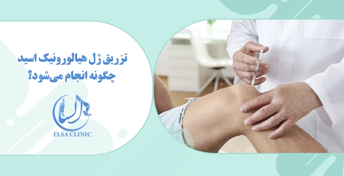 تزریق ژل هیالورونیک اسید چگونه انجام می‌شود؟