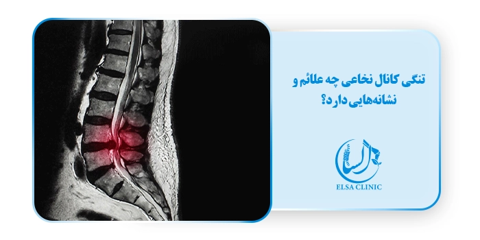 تنگی کانال نخاعی چه علائم و نشانه‌هایی دارد؟