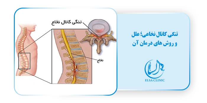 تنگی کانال نخاعی؛ علل و روش های درمان آن