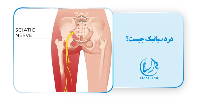 درد سیاتیک چیست؟