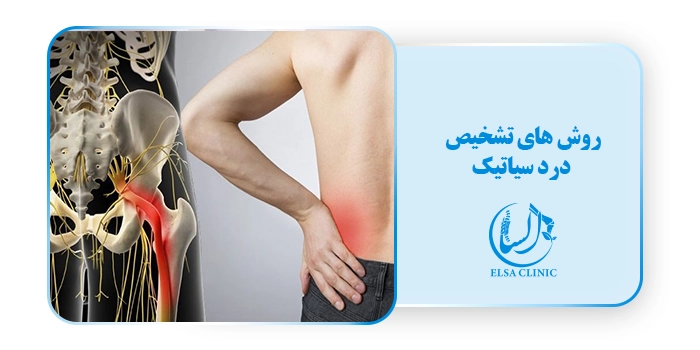 روش های تشخیص درد سیاتیک