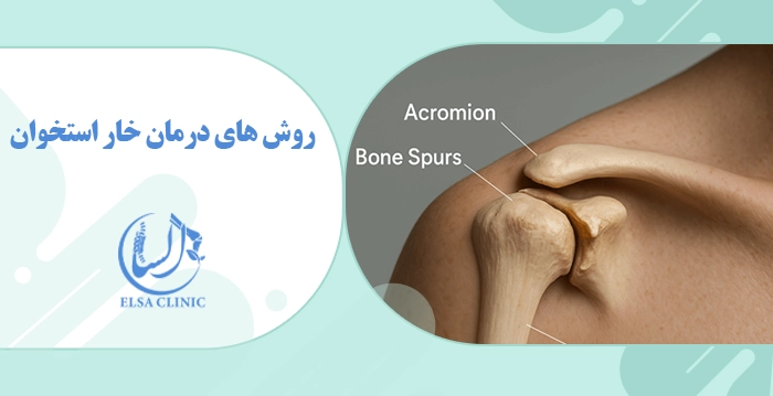 Methods of treating bone spurs