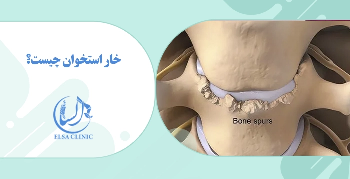 خار استخوان چیست؟