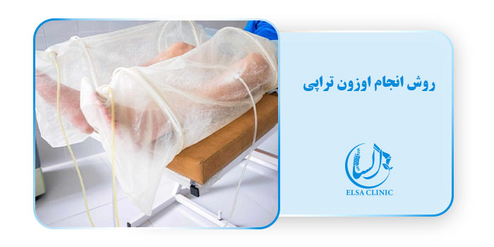 روش انجام اوزون تراپی