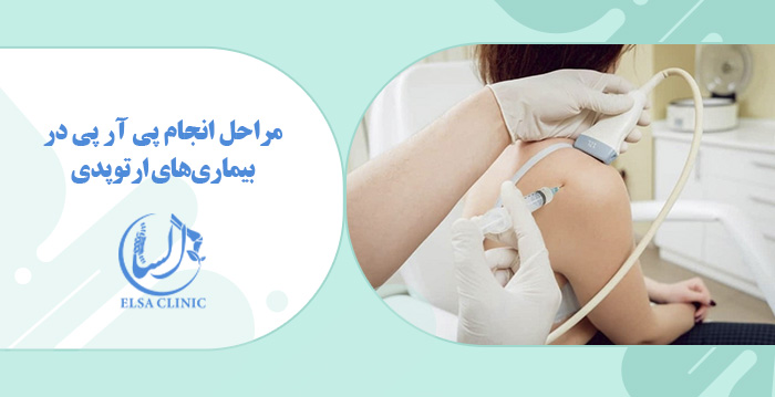مراحل انجام پی آر پی در بیماری‌های ارتوپدی