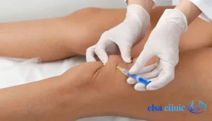 پی آر پی تراپی