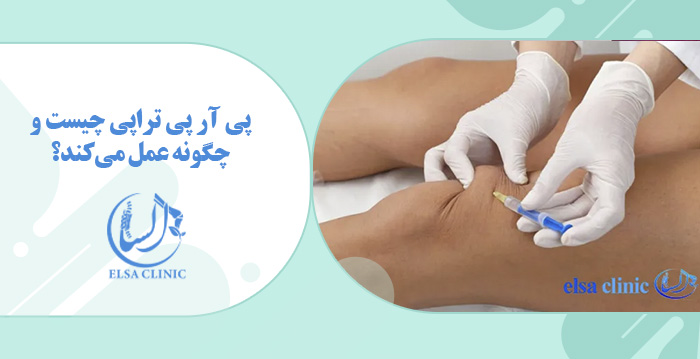 پی آر پی تراپی چیست و چگونه عمل می‌کند؟