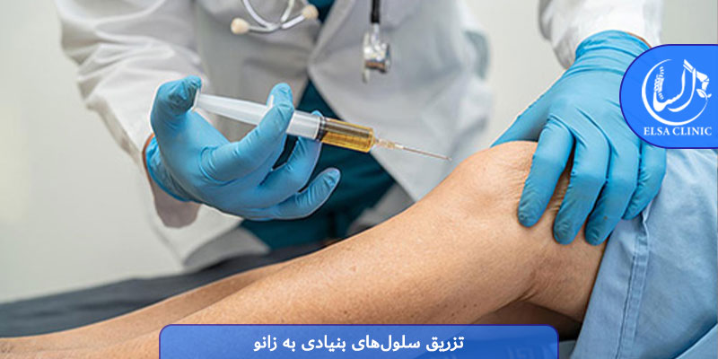 تزریق سلول‌های بنیادی به زانو