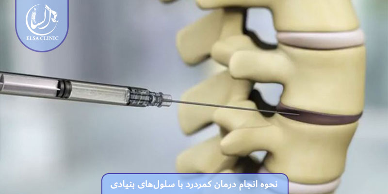 نحوه انجام درمان کمردرد با سلول‌های بنیادی