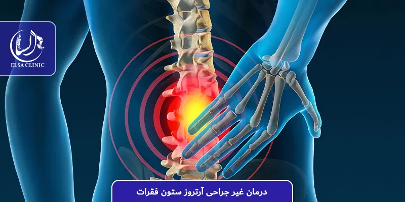 درمان غیر جراحی آرتروز ستون فقرات