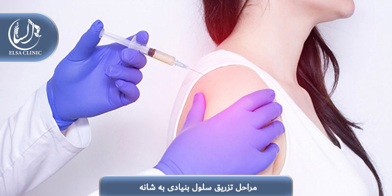 مراحل تزریق سلول بنیادی به شانه