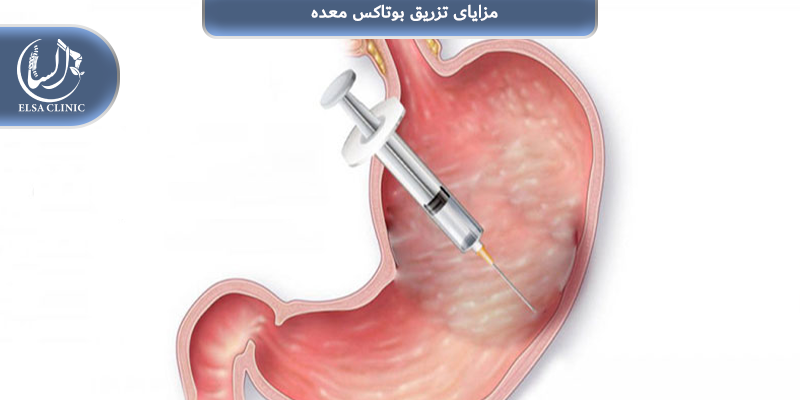 مزایای تزریق بوتاکس معده