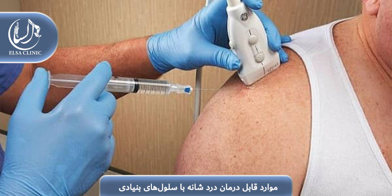 موارد قابل درمان درد شانه با سلول‌های بنیادی