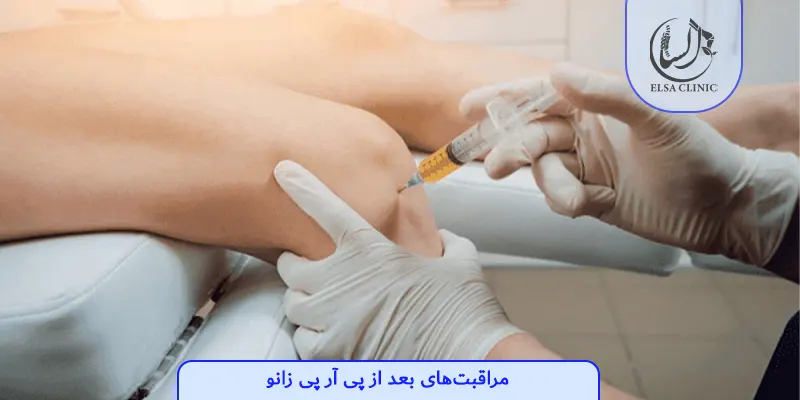 مراقبت‌های بعد از پی آر پی زانو