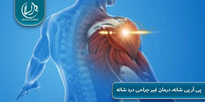 پی آر پی شانه، درمان غیر جراحی درد شانه