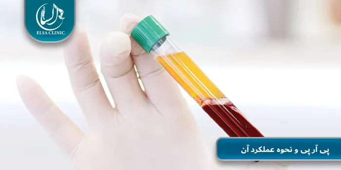 پی آر پی و نحوه عملکرد آن