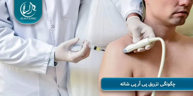 چگونگی تزریق پی آر پی شانه
