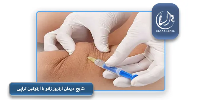 نتایج درمان آرتروز زانو با ارتوکین تراپی