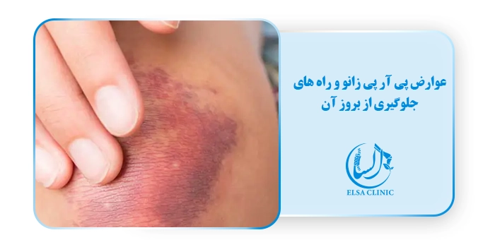 عوارض پی آر پی زانو و راه های جلوگیری از بروز آن