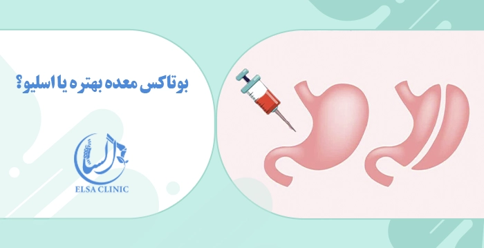 بوتاکس معده بهتره یا اسلیو؟