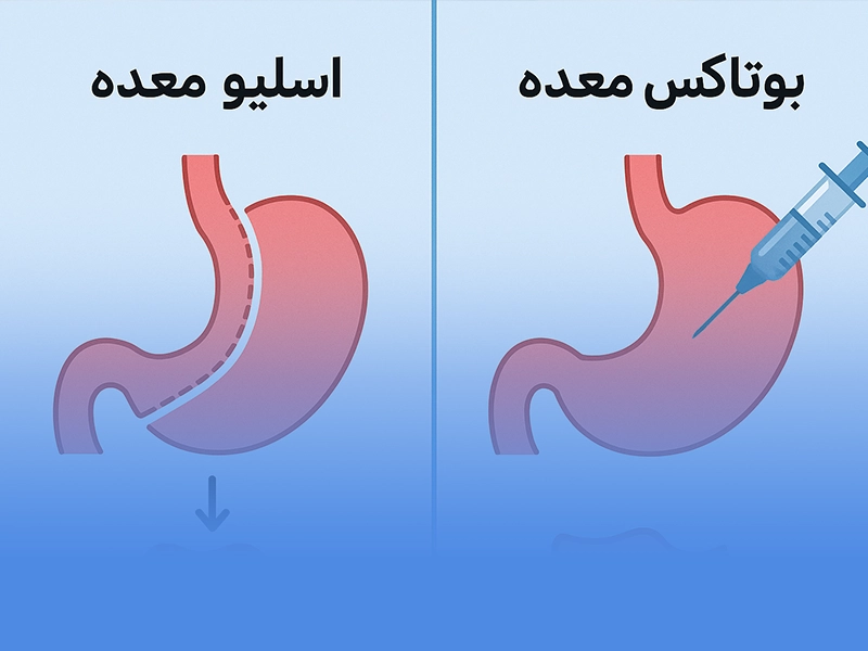 بوتاکس معده و اسلیو معده
