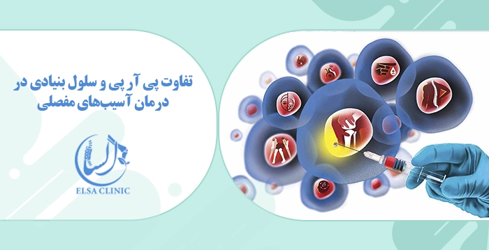 تفاوت پی ‌آر‌ پی و سلول بنیادی در درمان آسیب‌های مفصلی