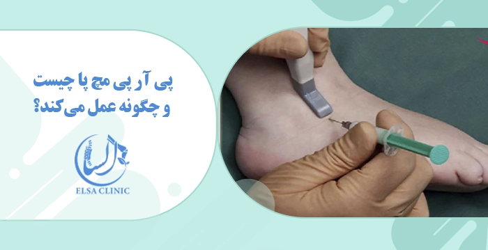 پی آر پی مچ پا چیست و چگونه عمل می‌کند؟