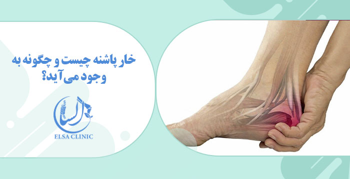 خار پاشنه چیست و چگونه به وجود می‌آید؟